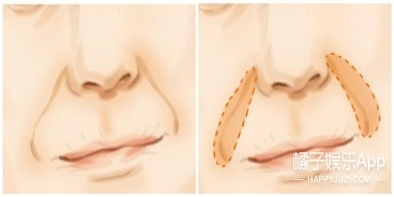 嘴角八字纹是什么原因出现的(除了手纹和颈纹)