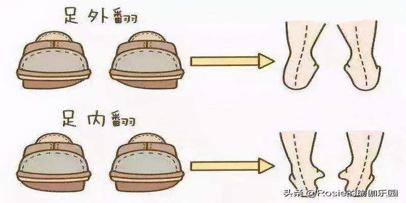 脚踝骨外翻(骨盆后倾大腿外翻)