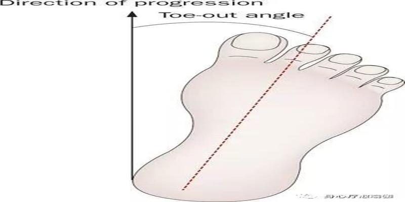 外八字脚会引起膝关节损伤吗