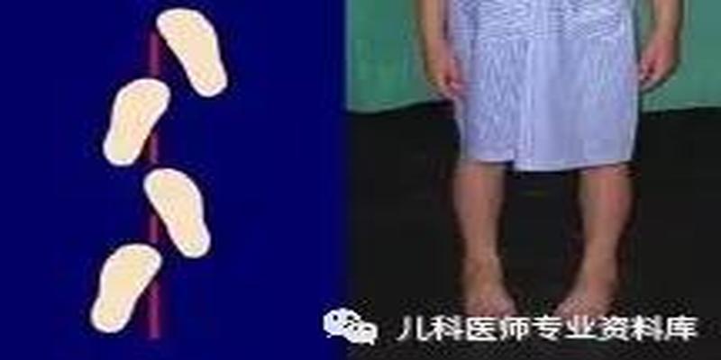 宝宝走路内八字鞋子反穿有用吗(儿童内八字脚)